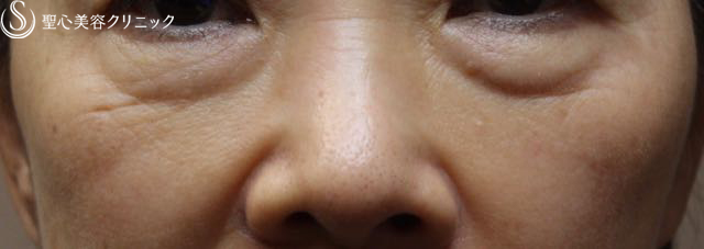 【60代女性・プレミアムPRP 皮膚再生療法】目の下のクマ（6ヶ月後） Before 