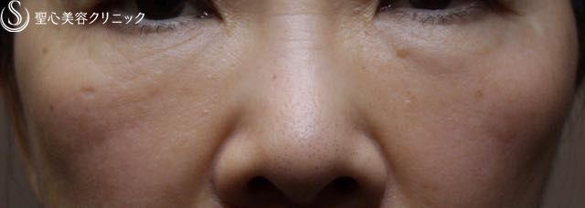 【60代女性・プレミアムPRP 皮膚再生療法】目の下のクマ（6ヶ月後） After 