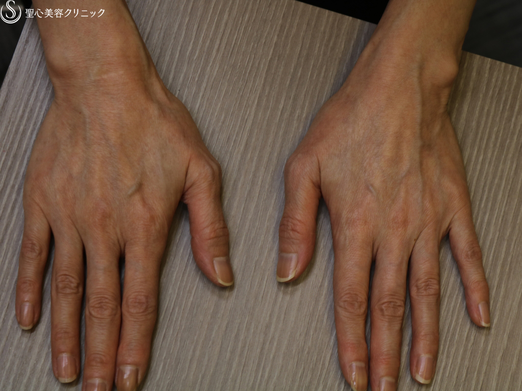 【50代女性・手の甲の若返り】プレミアムPRP皮膚再生療法（3ヶ月後） Before 