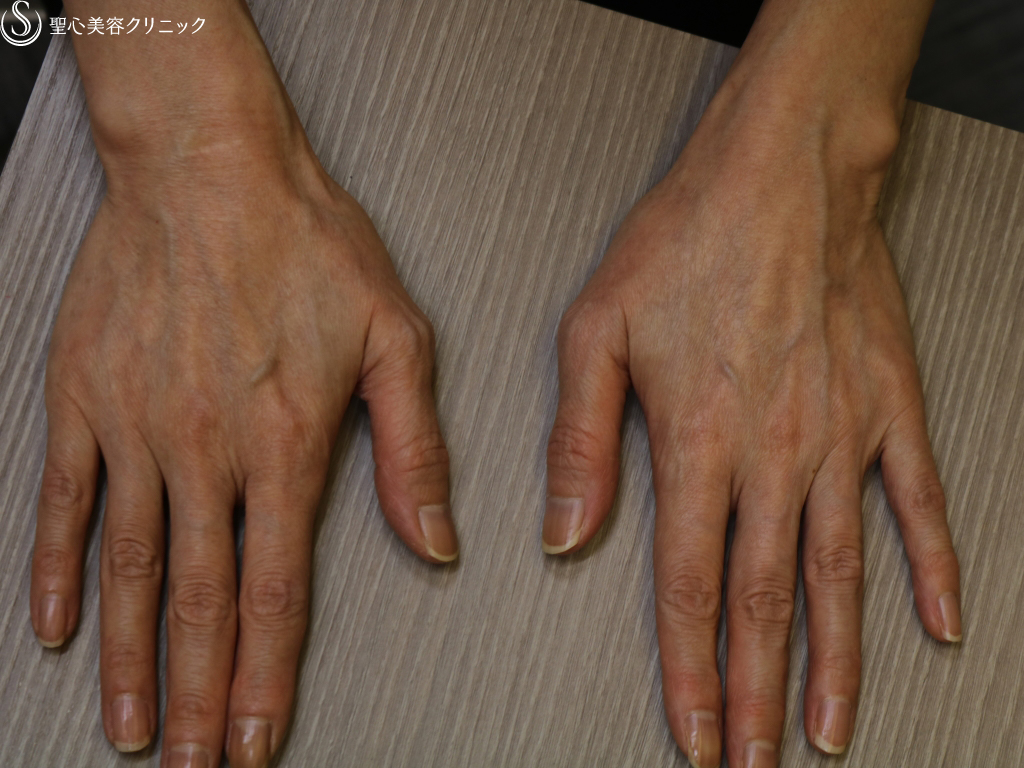 50代女性 手の甲の若返り プレミアムprp皮膚再生療法 3ヶ月後 症例写真 美容整形 美容外科なら聖心美容クリニック 50代女性 手の甲の若返り プレミアムprp皮膚再生療法 3ヶ月後 症例写真 美容整形 美容外科なら聖心美容クリニック