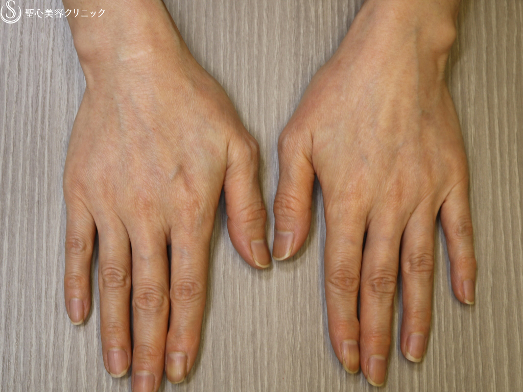 【50代女性・手の甲の若返り】プレミアムPRP皮膚再生療法（3ヶ月後） After 