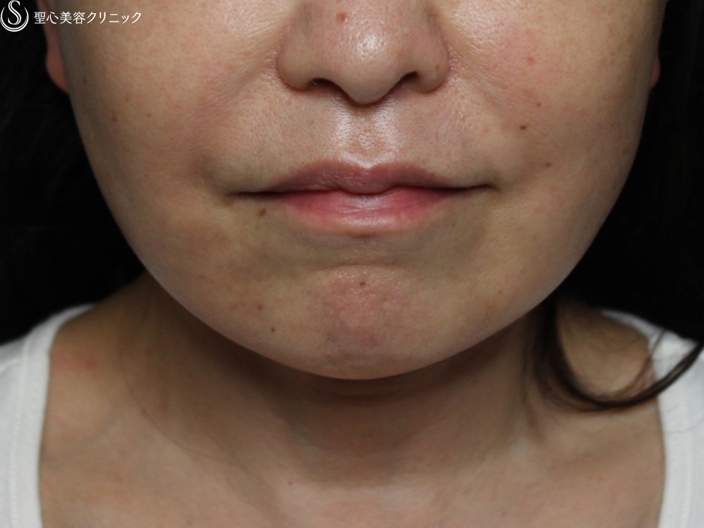 【60代女性・フェイスラインと頬のたるみを改善】プレミアムミニリフト+頬ベイザー脂肪吸引（１か月後） After 