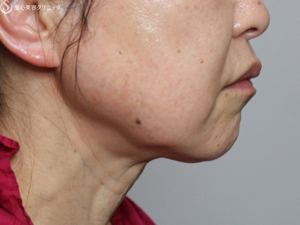 【60代女性・フェイスラインと頬のたるみを改善】プレミアムミニリフト+頬ベイザー脂肪吸引（１か月後） Before 