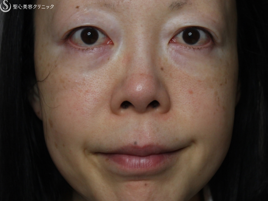 【40代女性・自然な二重とすっきりとした鼻筋に】二重埋没法、鼻の複合手術（1ヶ月後） Before 