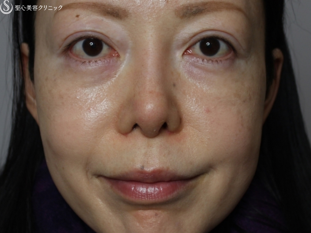 【40代女性・自然な二重とすっきりとした鼻筋に】二重埋没法、鼻の複合手術（1ヶ月後） After 