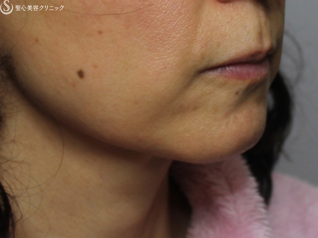【40代女性・すっきりとした印象に】プレミアムミニリフト+頬一部ベイザー脂肪吸引（術後２か月） Before 