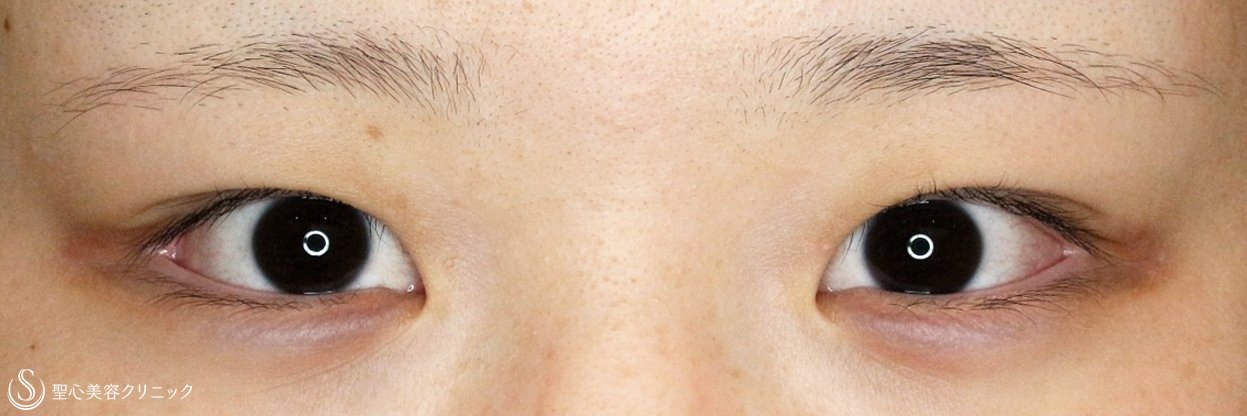 【20代女性・華やかな目に】二重マイクロメソッド+α ＆目頭切開（9ヶ月後） Before 