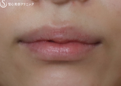 【20代女性・唇も可愛く】スマイルリップ（3ヶ月後） After 