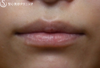 【20代女性・唇も可愛く】スマイルリップ（3ヶ月後） Before 
