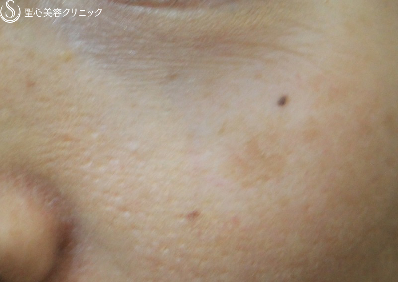【女性・気になるホクロを除去】ホクロ 電気凝固法 左目の下(3週間後) Before 