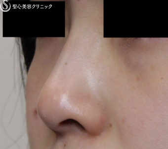 【20代女性・鼻先美人に】鼻尖縮小・耳介軟骨移植（1ヶ月後） Before 