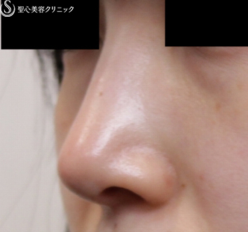 【20代女性・鼻先美人に】鼻尖縮小・耳介軟骨移植（1ヶ月後） After 
