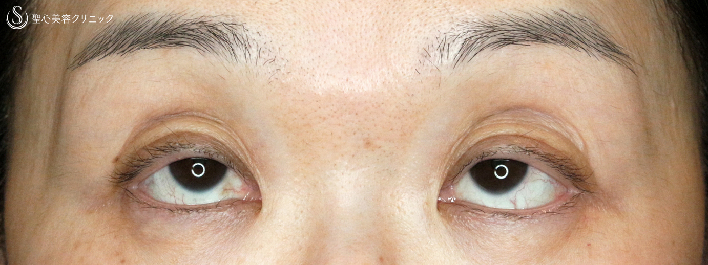 【50代女性・コンタクトレンズによる下垂に複合治療】切らない眼瞼下垂+α法＆眉下リフト（5年後） Before 