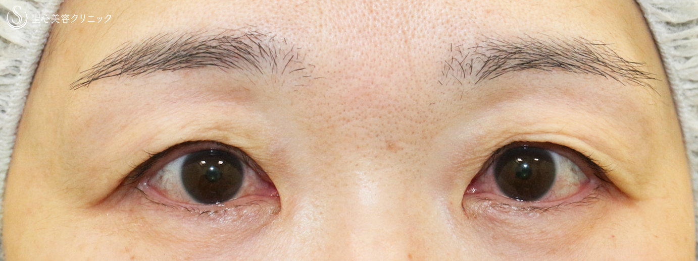 【50代女性・コンタクトレンズによる下垂に複合治療】切らない眼瞼下垂+α法＆眉下リフト（5年後） Before 