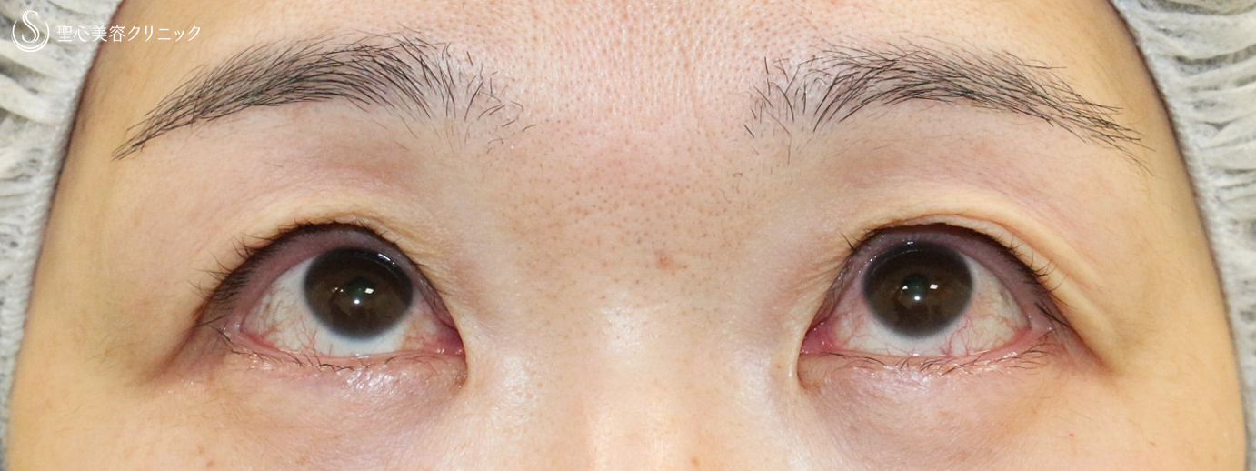 【50代女性・コンタクトレンズによる下垂に複合治療】切らない眼瞼下垂+α法＆眉下リフト（4年後） Before 