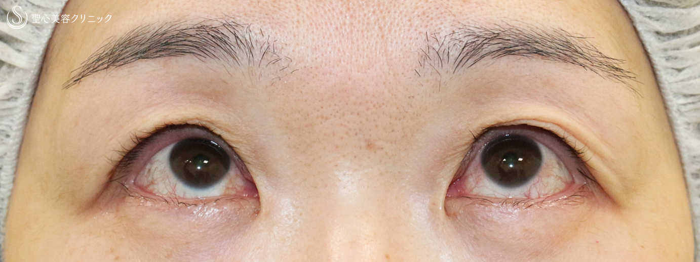 【50代女性・コンタクトレンズによる下垂】切らない眼瞼下垂+α法（1年後） 症例写真 美容整形、美容外科なら聖心美容クリニック