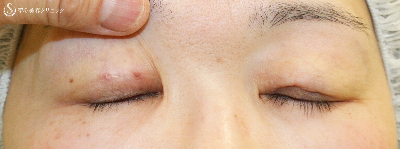 【50代女性・コンタクトレンズによる下垂に複合治療】切らない眼瞼下垂+α法＆眉下リフト（5年後） After 