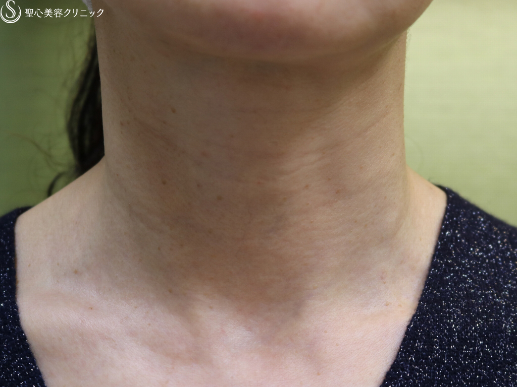 【60代女性・首の横じわの改善】プレミアムPRP皮膚再生療法（3ヶ月後） After 