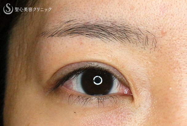 【20代女性・他院眼瞼下垂術後の修正】二重全切開+α法（1ヶ月後） After 