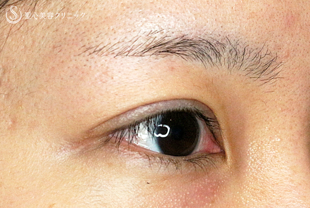 【20代女性・他院眼瞼下垂術後の修正】二重全切開+α法（1ヶ月後） After 