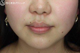 【女性・アゴのヒアルロン酸注入でスッキリ小顔効果】ヒアルロン酸注入（注入直後） Before 