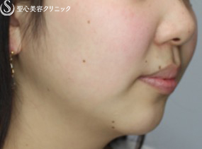 【女性・アゴのヒアルロン酸注入でスッキリ小顔効果】ヒアルロン酸注入（注入直後） Before 