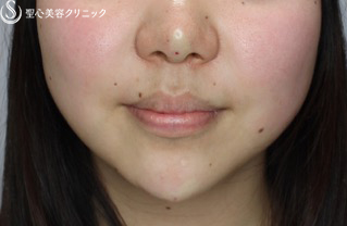【女性・アゴのヒアルロン酸注入でスッキリ小顔効果】ヒアルロン酸注入（注入直後） After 
