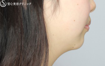 【女性・アゴのヒアルロン酸注入でスッキリ小顔効果】ヒアルロン酸注入（注入直後） Before 