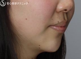 【女性・アゴのヒアルロン酸注入でスッキリ小顔効果】ヒアルロン酸注入（注入直後） After 