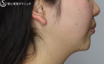 【女性・アゴのヒアルロン酸注入でスッキリ小顔効果】ヒアルロン酸注入（注入直後） After 