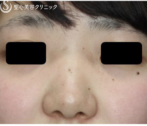 女性 鼻筋スッキリ gメッシュ 施術直後 症例写真 美容整形 美容外科なら聖心美容クリニック
