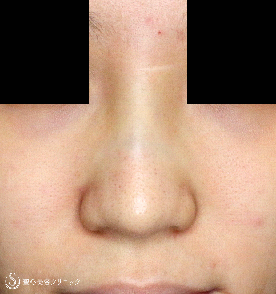 【20代女性・満足度が高い鼻のプチ整形】Gメッシュ（4年後） Before 