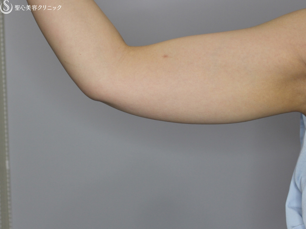 【40代女性・二の腕のたるみを改善】二の腕ベイザー脂肪吸引（3ヶ月後） Before 