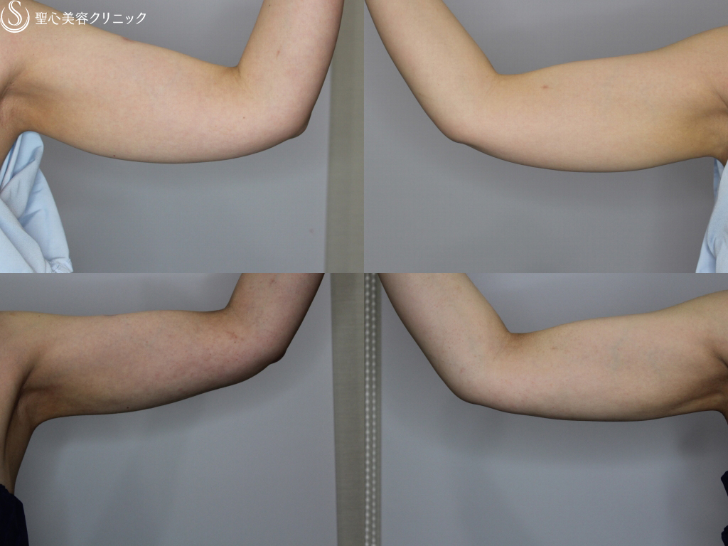 【40代女性・二の腕のたるみを改善】二の腕ベイザー脂肪吸引（3ヶ月後） After 