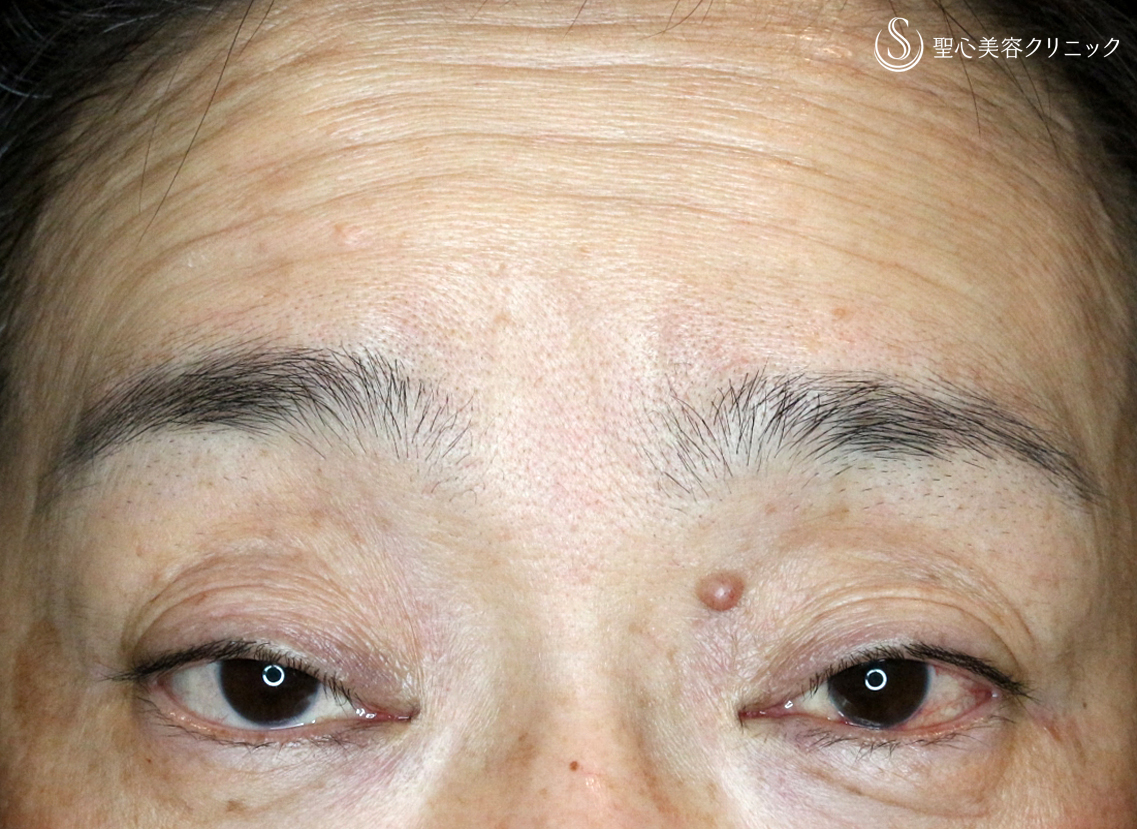 【50代女性・重度のコンタクト性眼瞼下垂】切らない眼瞼下垂+α法（術後1ヶ月） Before 