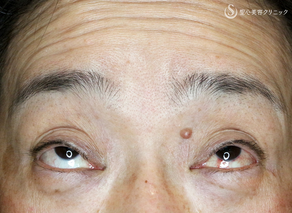 【50代女性・重度のコンタクト性眼瞼下垂】切らない眼瞼下垂+α法（術後1ヶ月） Before 