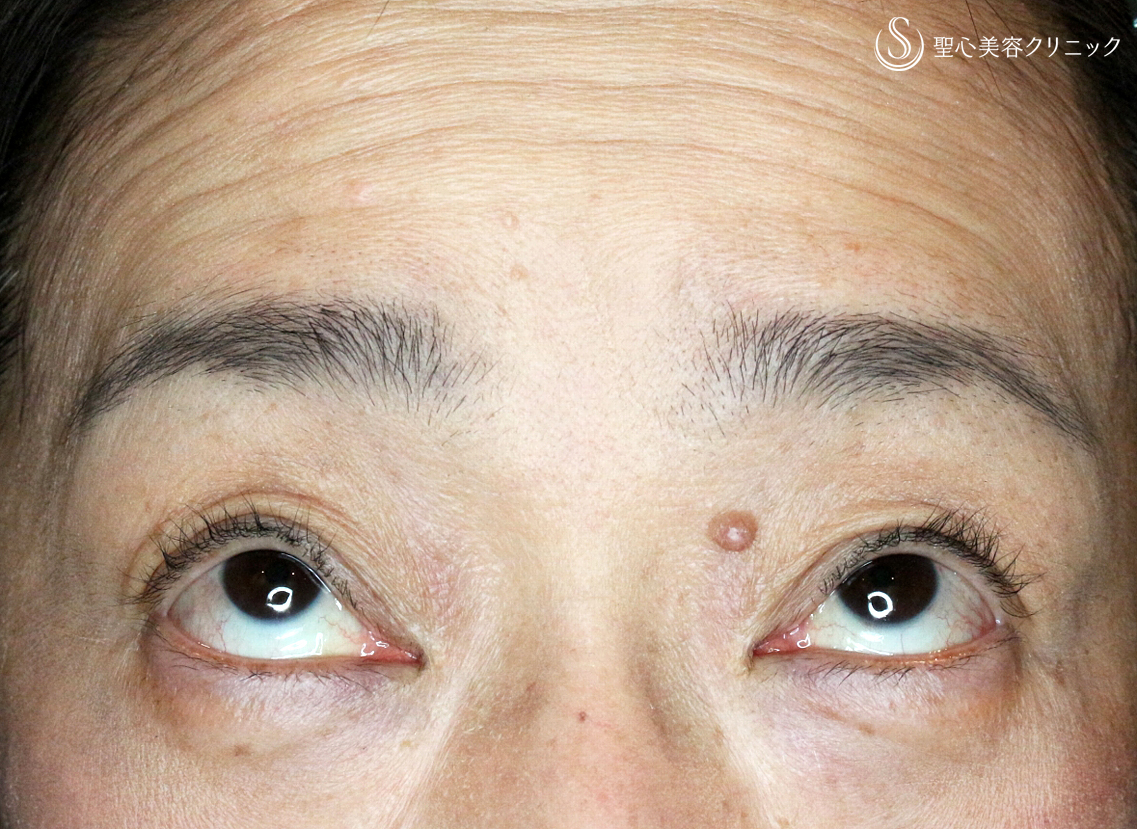 【50代女性・重度のコンタクト性眼瞼下垂】切らない眼瞼下垂+α法（術後1ヶ月） After 