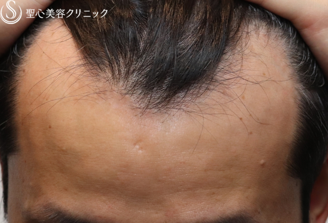 【40代男性・抜け毛が減り頭頂部のボリュームアップ】プレミアムグロースファクター（12回後） Before 
