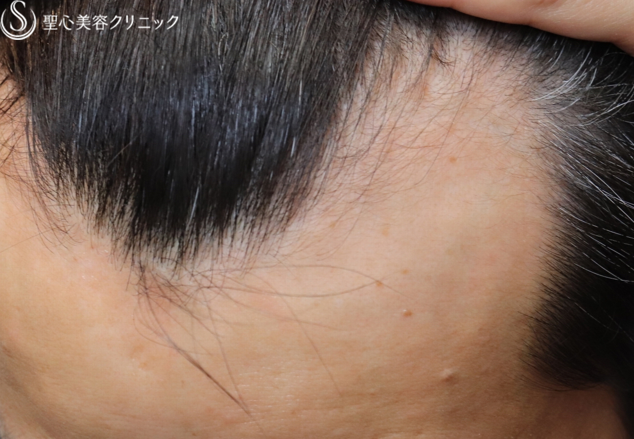 【40代男性・抜け毛が減り頭頂部のボリュームアップ】プレミアムグロースファクター（12回後） After 