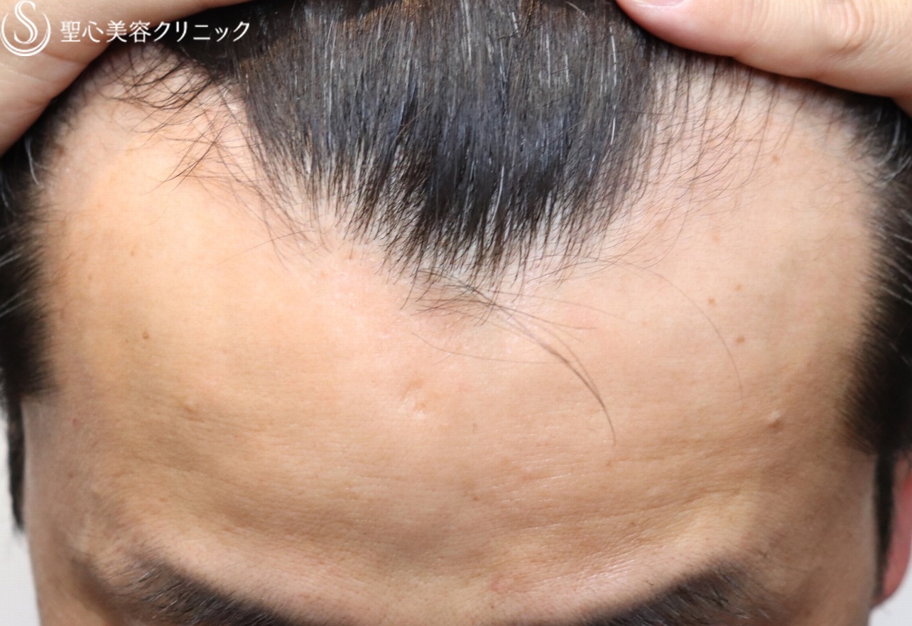 【40代男性・抜け毛が減り頭頂部のボリュームアップ】プレミアムグロースファクター（12回後） After 