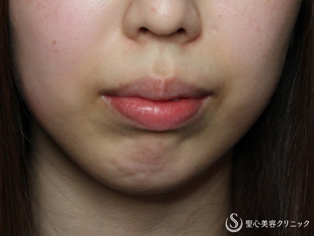 【20代女性・鼻の下を短く】リップリフト（1ヶ月後） Before 