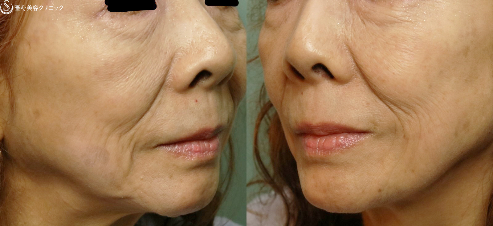 【60代女性・目の下のくま、ほうれい線】プレミアムPRP皮膚再生療法（6ヶ月後） Before 