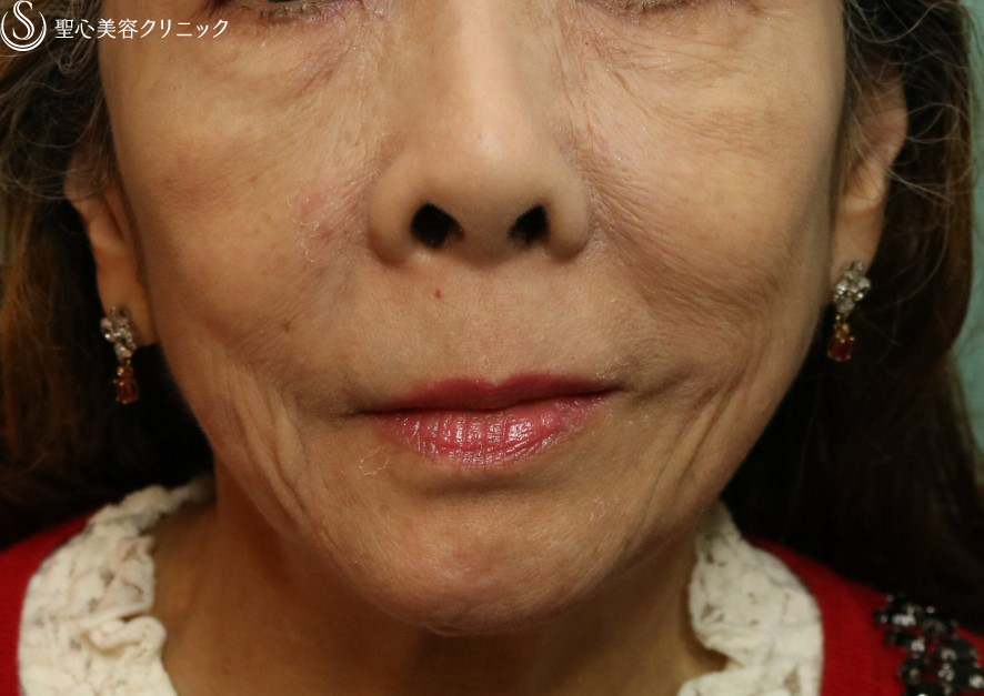 【60代女性・目の下のくま、ほうれい線】プレミアムPRP皮膚再生療法（6ヶ月後） After 