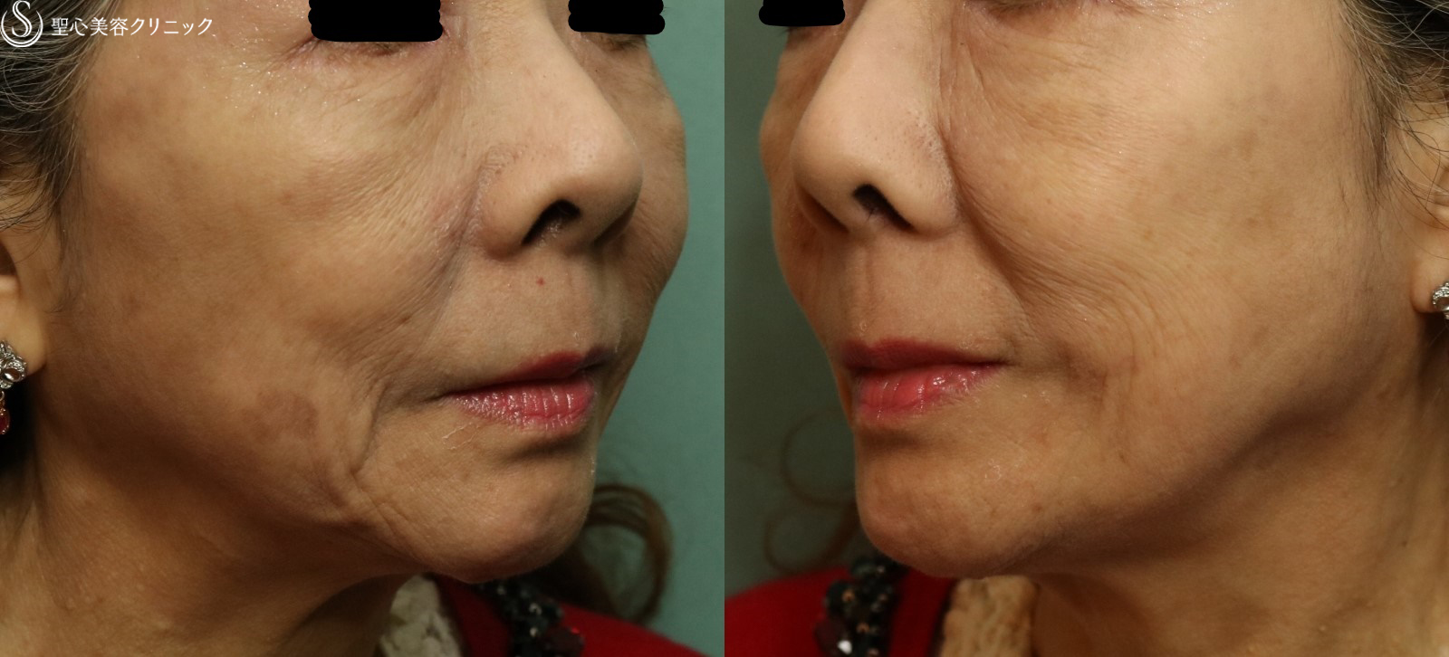 【60代女性・目の下のくま、ほうれい線】プレミアムPRP皮膚再生療法（6ヶ月後） After 