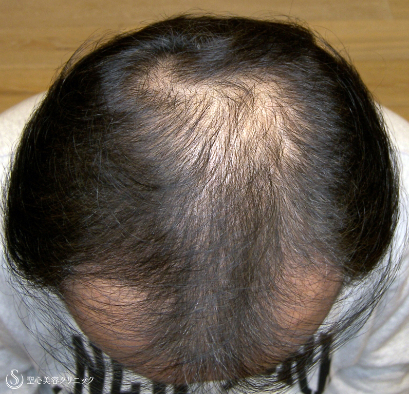 【50代男性・明らかな発毛効果】プレミアム・グロースファクター毛髪再生療法（6回後） After 