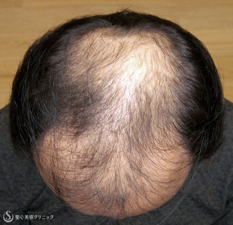【50代男性・明らかな発毛効果】プレミアム・グロースファクター毛髪再生療法（6回後） Before 