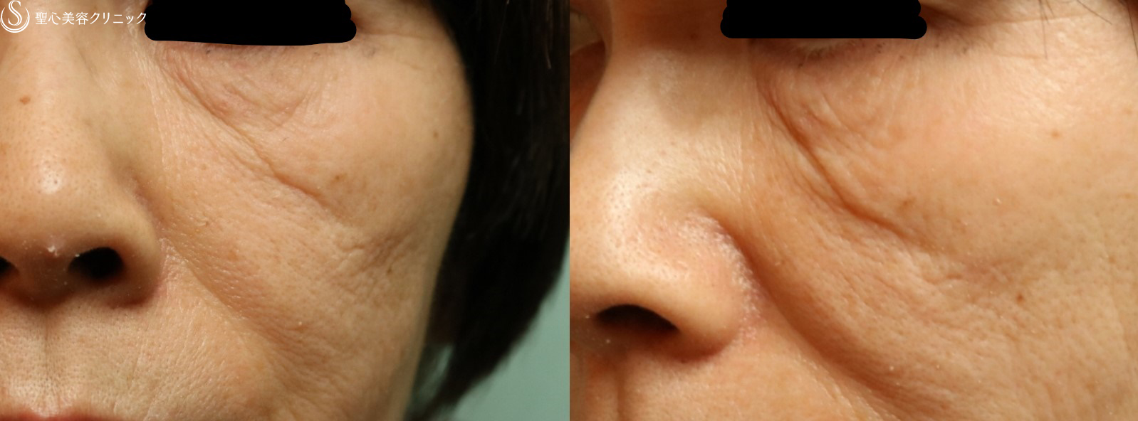 【60代女性・インディアンライン】プレミアムPRP皮膚再生療法（3ヶ月後） Before 