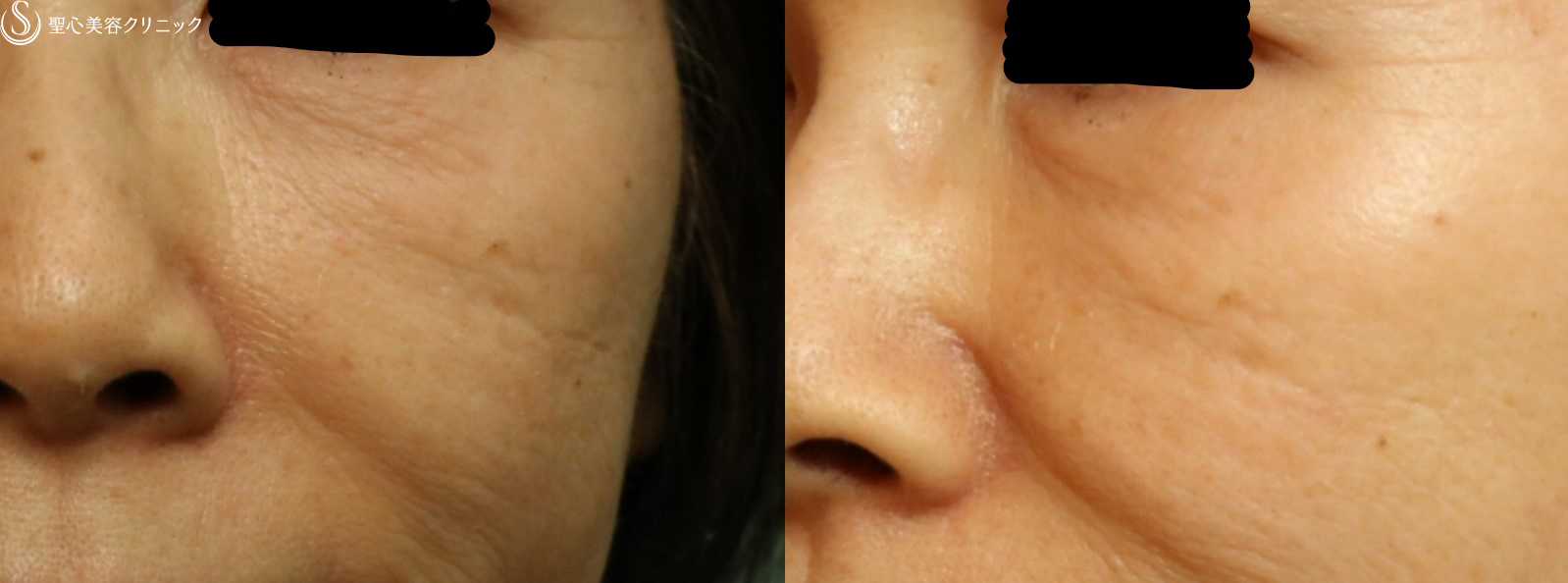 【60代女性・インディアンライン】プレミアムPRP皮膚再生療法（3ヶ月後） After 