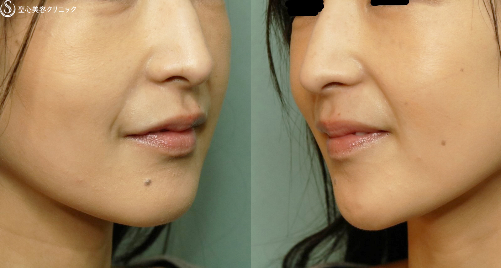【30代女性・ほうれい線】プレミアムPRP皮膚再生療法（1年３ヶ月後） Before 