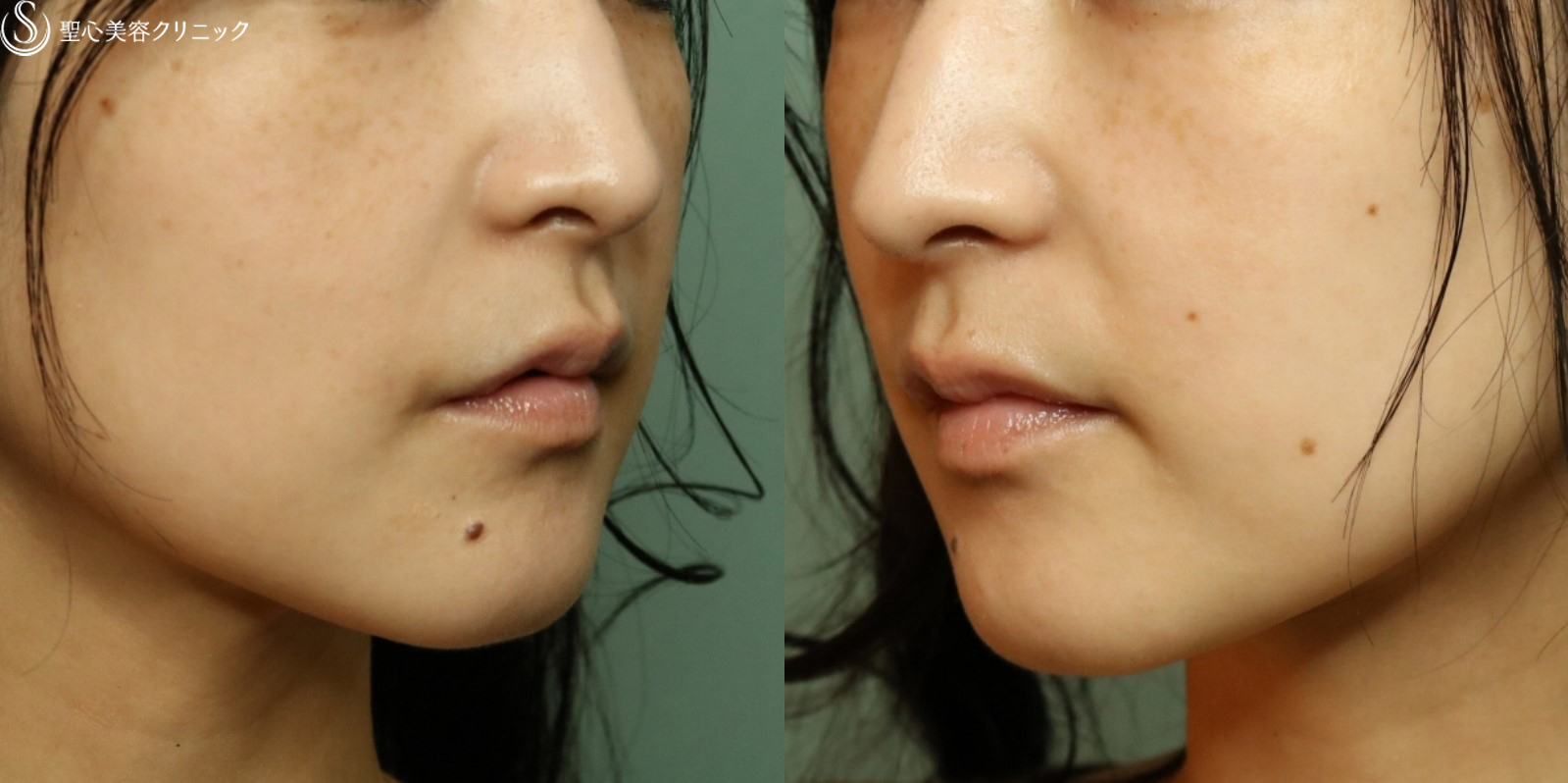 【30代女性・ほうれい線】プレミアムPRP皮膚再生療法（1年３ヶ月後） After 